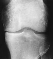Болезнь бехтерева коленный сустав